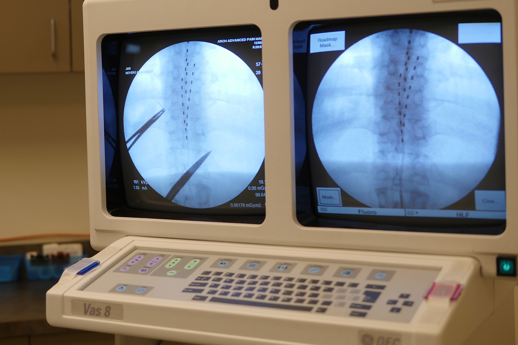 High Freq Spinal Cord Stimulation Arch Advanced Pain Management