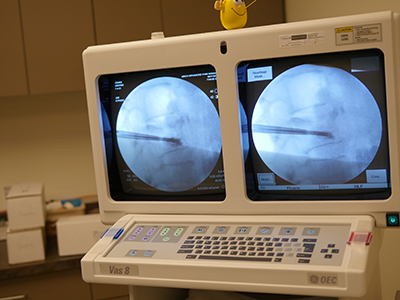 Monitoring the flow of liquid Plexiglas during Kyphoplasty Monitoring Kyphoplasty injection