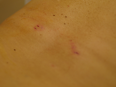 Kyphoplasty15
