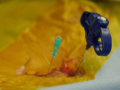 Kyphoplasty7