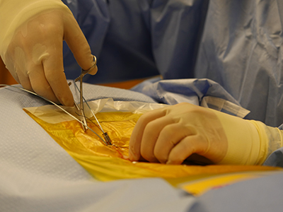 closing-SCS-lead-implant