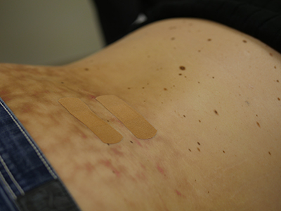 epidural6