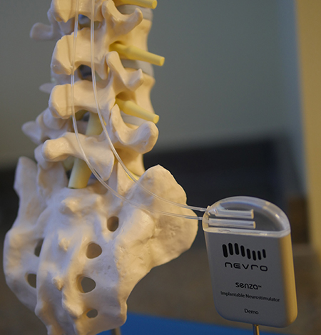 Nevro High-Frequency Spinal Cord Stimulation