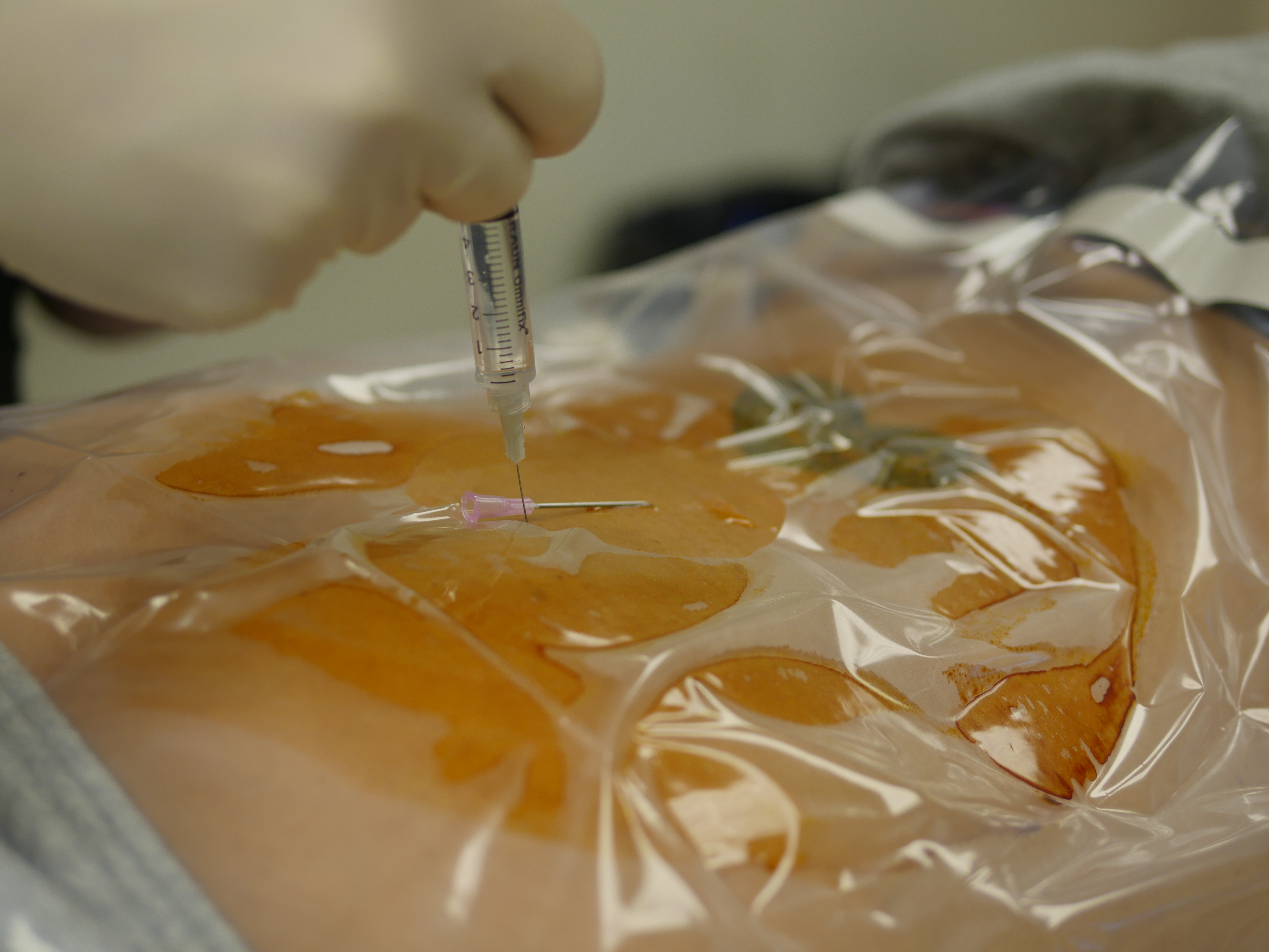 radio_frequency_ablation_4 Radiofrequency Ablation 6