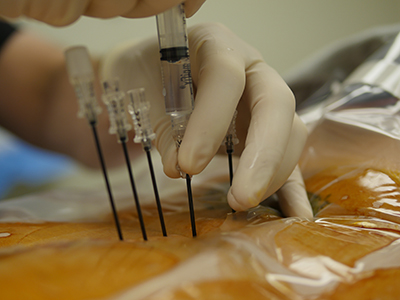 radio_frequency_ablation_9 Radiofrequency Ablation 13