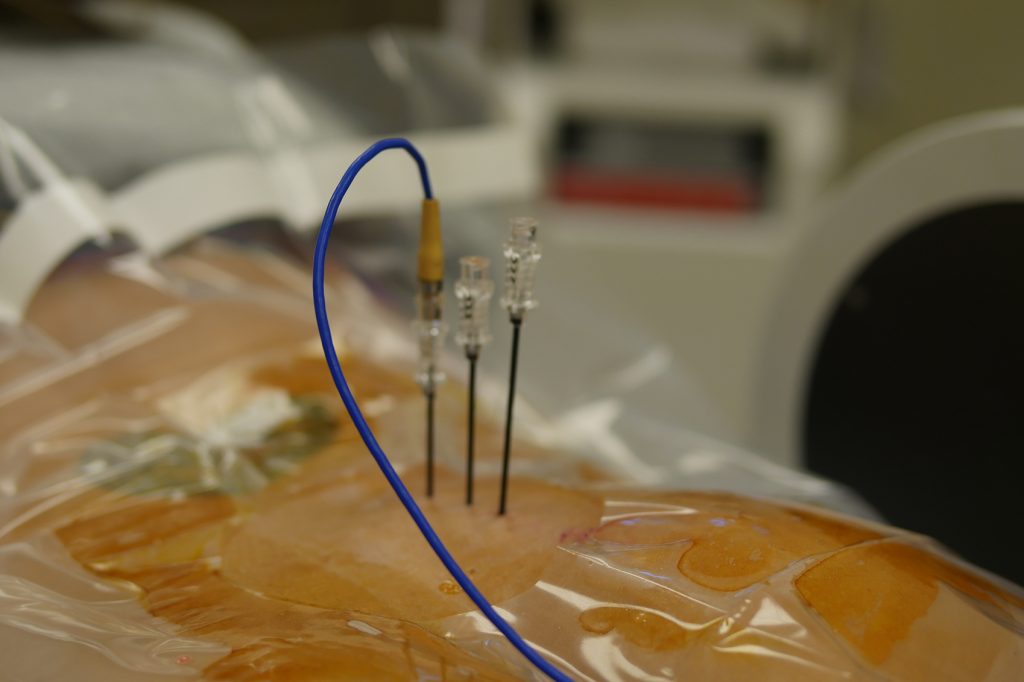 Radiofrequency Ablation St. Peters, MO Arch Advanced Pain Management