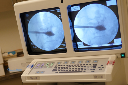 Compression Fractures / Kyphoplasty Compression Fractures