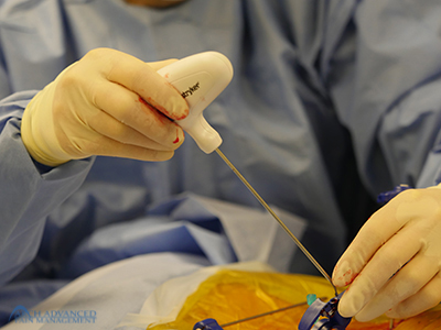Kyphoplasty Compression Fractures