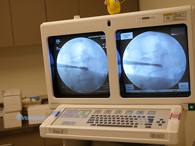 Kyphoplasty Compression Fractures