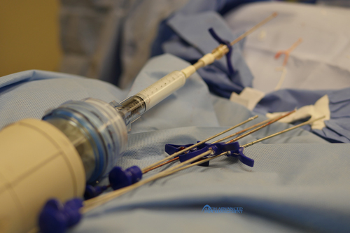 Kyphoplasty - Arch Advanced Pain Management Compression Fractures