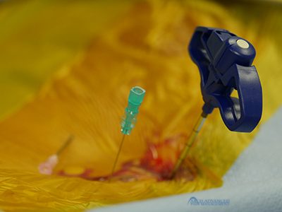 Kyphoplasty Compression Fractures