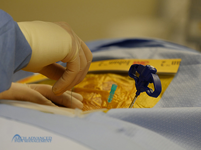 Kyphoplasty Compression Fractures