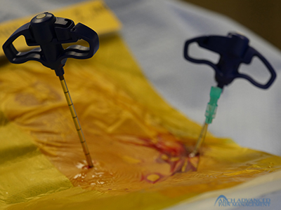 Kyphoplasty Compression Fractures