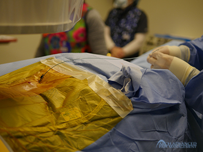 SCS-electrode-implant High-Frequency Spinal Cord Stimulation