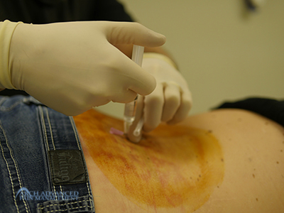 Epidural Steroid Injection - Arch Advanced Pain Management Epidural Steroid Injection
