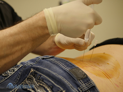 Epidural Steroid Injection - Arch Advanced Pain Management Epidural Steroid Injection