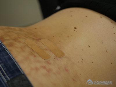 Epidural Steroid Injection - Arch Advanced Pain Management Epidural Steroid Injection