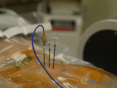 Radiofrequency Ablation | Nuerotomy | Arch Advanced Pain Management