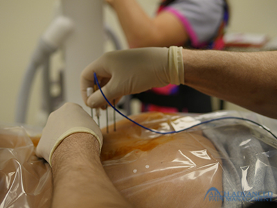 radio_frequency_ablation_14 Radiofrequency Ablation 12