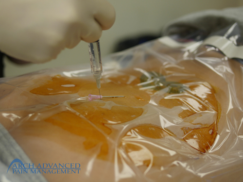 radio_frequency_ablation_4 Radiofrequency Ablation 6