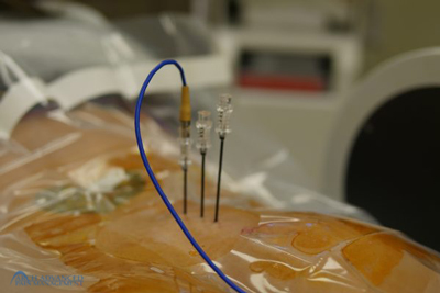 radio_frequency_ablation_y Radiofrequency Ablation 1