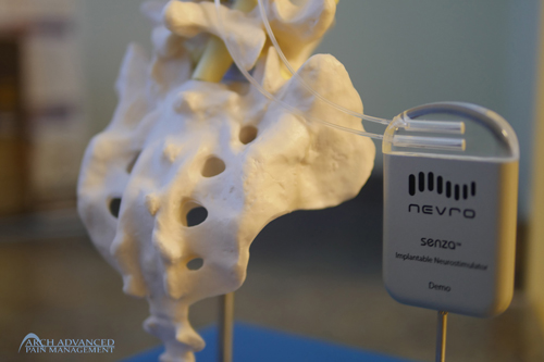 High Freq Spinal Cord Stimulation – Arch Advanced Pain Management