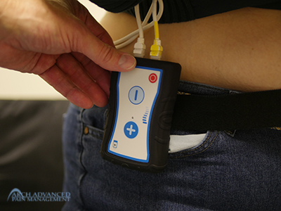 senza-trial-controler High-Frequency Spinal Cord Stimulation