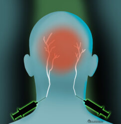 Occipital Neuralgia St. Peters, MO | Arch Advanced Pain Management