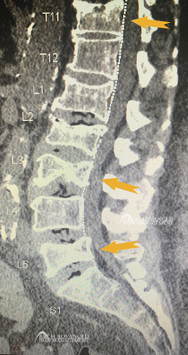 2020-before-compression-fractures X-Ray of a Compression Fracture