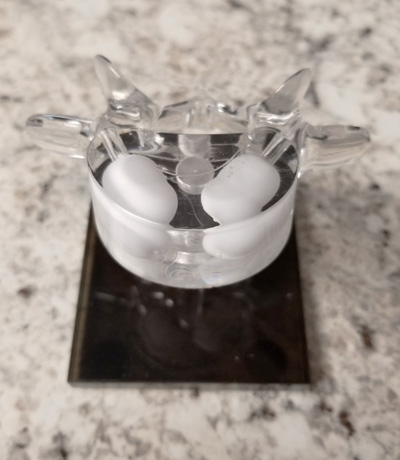Kyphoplasty-model Kyphoplasty Demo